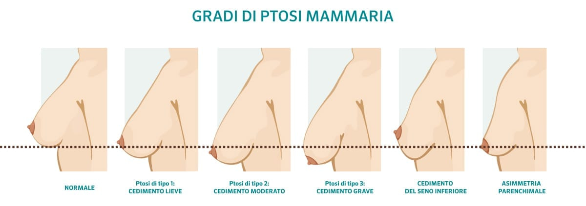 Gradi di ptosi mammaria