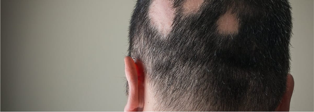 Alopecia androgenetica Roma