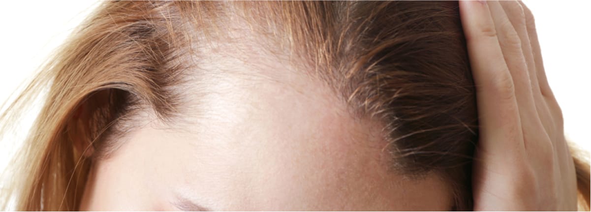 Alopecia femminile Roma
